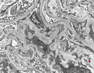 F,29y. | IgA nephropathy (purpura Henoch-Schonlein) F,29y. | IgA nephropathy (purpura Henoch-Schonlein)